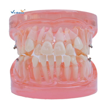 Orthodontic Model Ortho?Metal or Ceramic Bracket