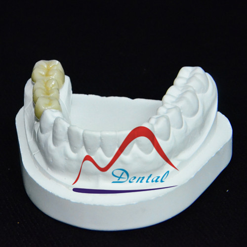 Dental full contour zirconia bridge