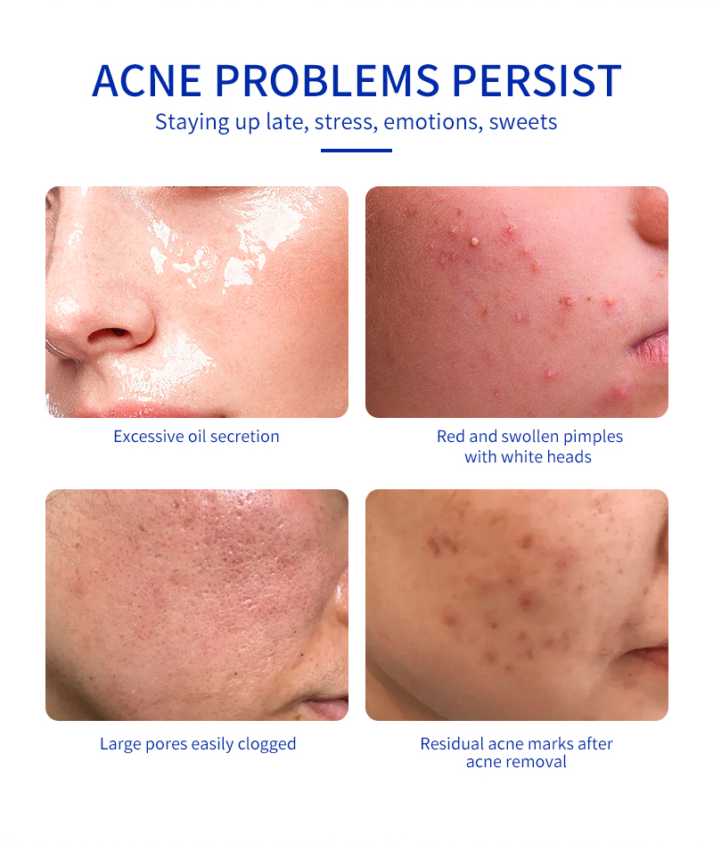 acne essential