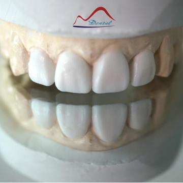 Aesthetic Dental Diagnostic Wax-up