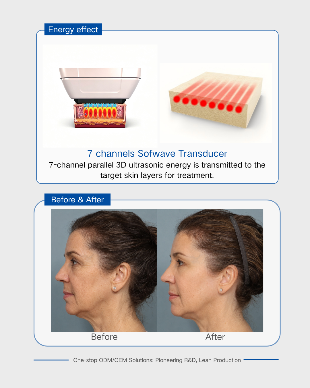 7 kanal Sofwave Dönüştürücü 7 channels Sofwave Transducer
