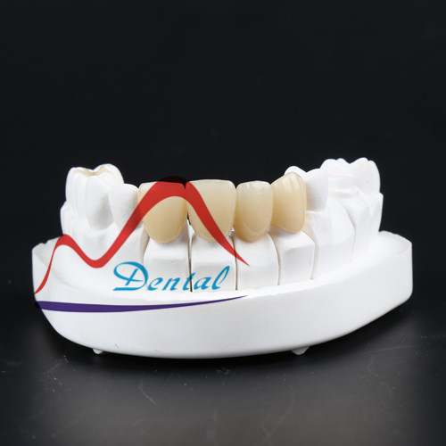 Zirconia crown