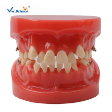 Orthodontic Dental  Model