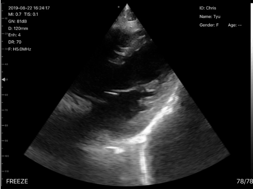 Double Head Wireless Ultrasound Probe Portable Doppler Ultrasound Convex and Linear Wireless Ultrasound