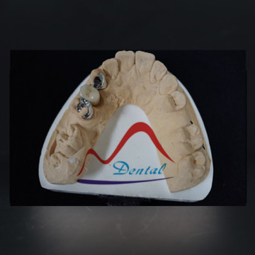 Individually made dental Maryland bridge