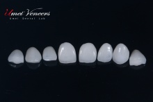 Natural clear zirconia veneers