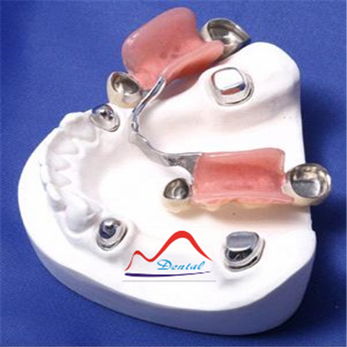 Retentive dental telescopic crown