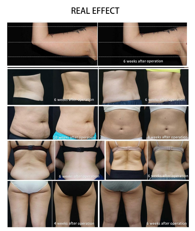 Cours de fonges Fat Freeze Course