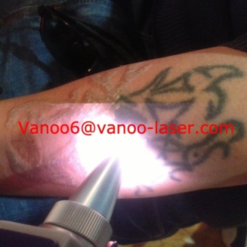 2015 Portable Nd yag laser machine/tattoo removal nd yag/laser skin whitening