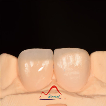 Dental All Ceramics CC Veneers