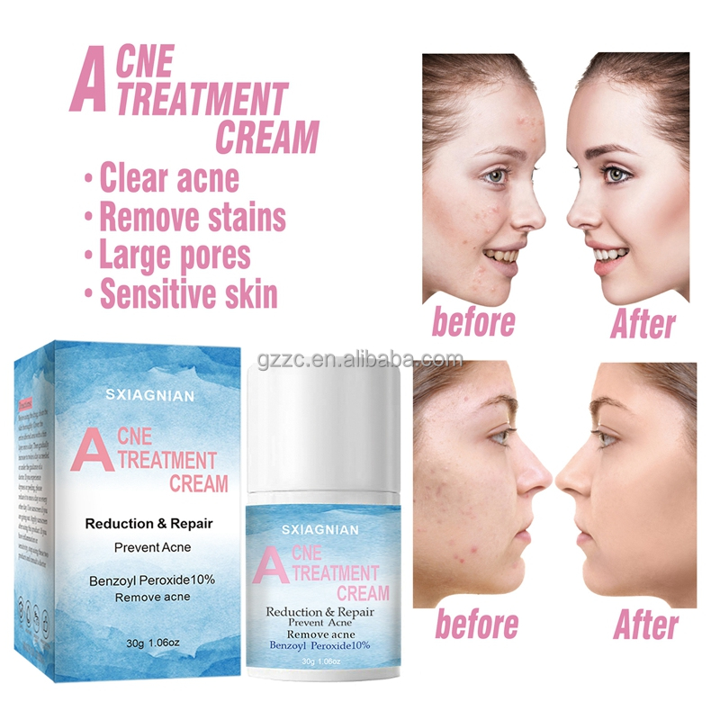 30g benzoyl peroxide 10% best pimple remove cream acne treatment cream oem for acne bleaching acne cream