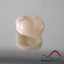 Dental Posterior Zirconia Restoration