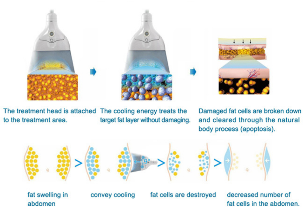 working theory of cryo body sculpting machine