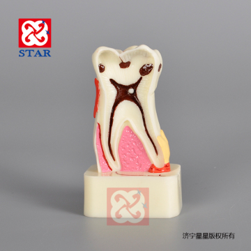 Single Tooth Anatomy Pathology Dental Model - 4 Times Magnification
