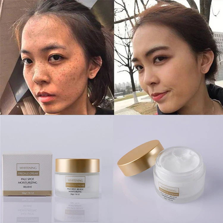 Powerful Whitening Freckle Cream Remove Melasma Acne Spots Pigment Melanin Dark Spots Face Care Cream