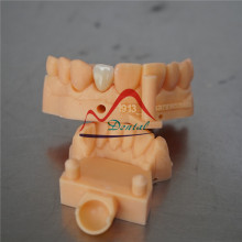 3Shape Digital Dental E-max Crown