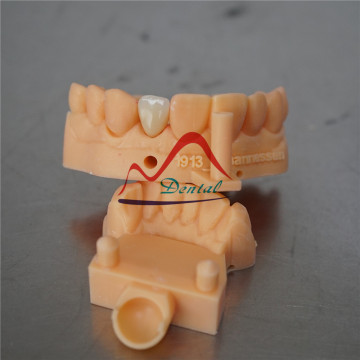 3Shape Digital Dental E-max Crown