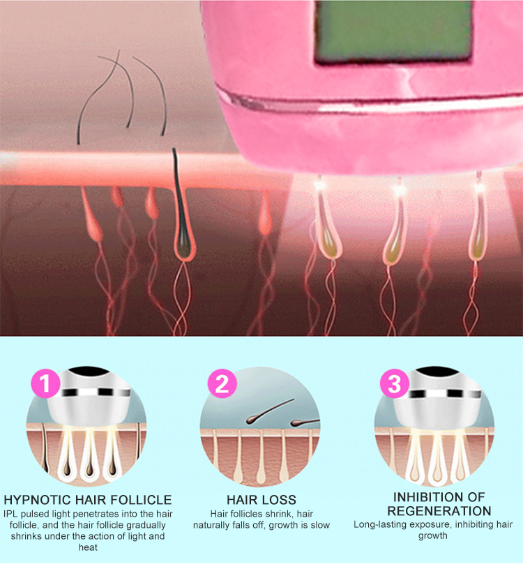 Máquina de remoção de cabelo a laser de cinco engrenagens de cinco engrenagens