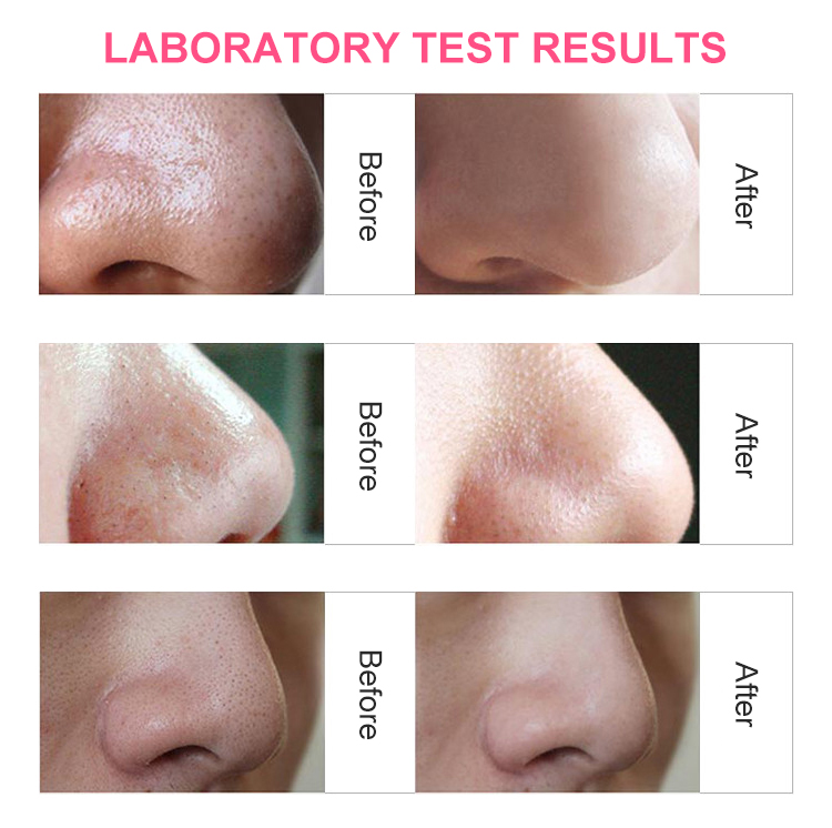 Portable skin care facial nose electric ultrasonic acne pore cleaner vacuum blackhead suction remover
