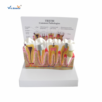 Combined model of common dental diseases