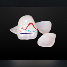 Dental Emax ceramic veneer Hollywood white lumineer