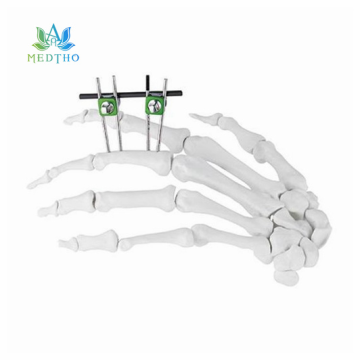 external fixation of fracture