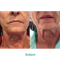 Injectable Neck Contouring Anti Wrinkles PLLA Dermal Filler