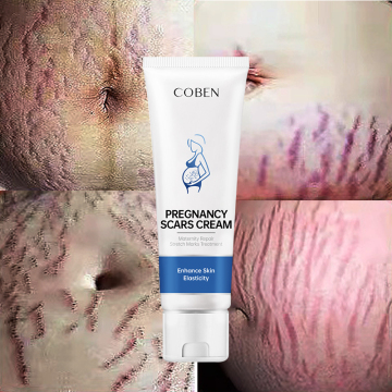 Private Label Female Body Stretch Mark Removal Lotion