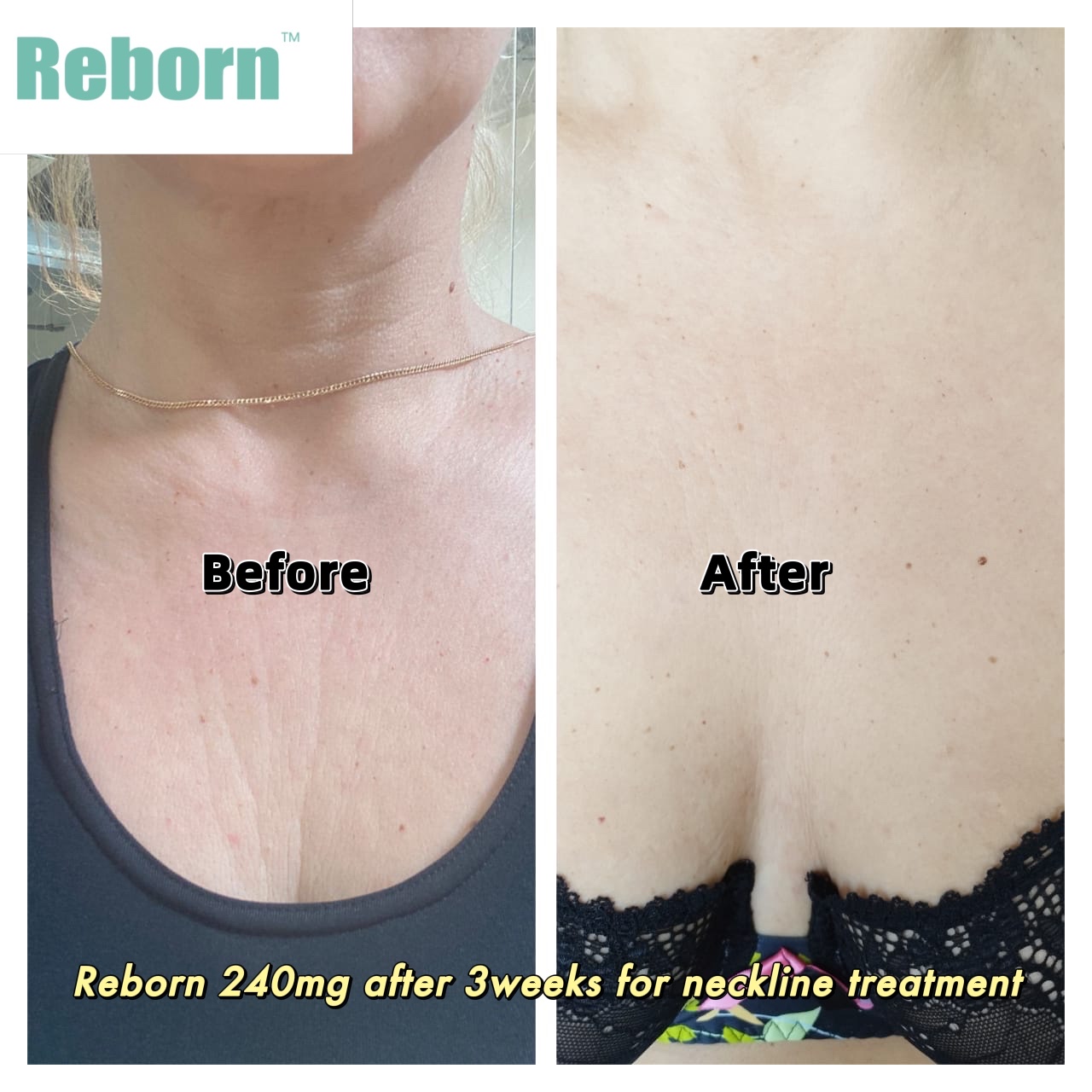 Reborn Plla Filler for neckline treatment