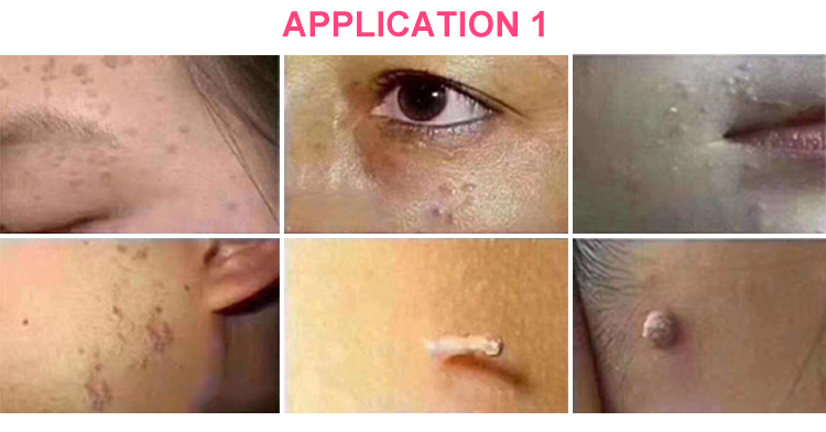 Pena plasma laser pemegang tersuai untuk penyingkiran freckle penjagaan kecantikan ketuat tempat gelap penyingkiran