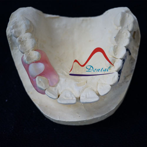 Unilateral Vlaplast denture finish