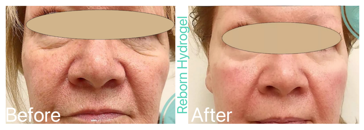 Reborn PLLA Hydrogel for mesotherapy