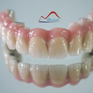 Long Dental Implant Bridge