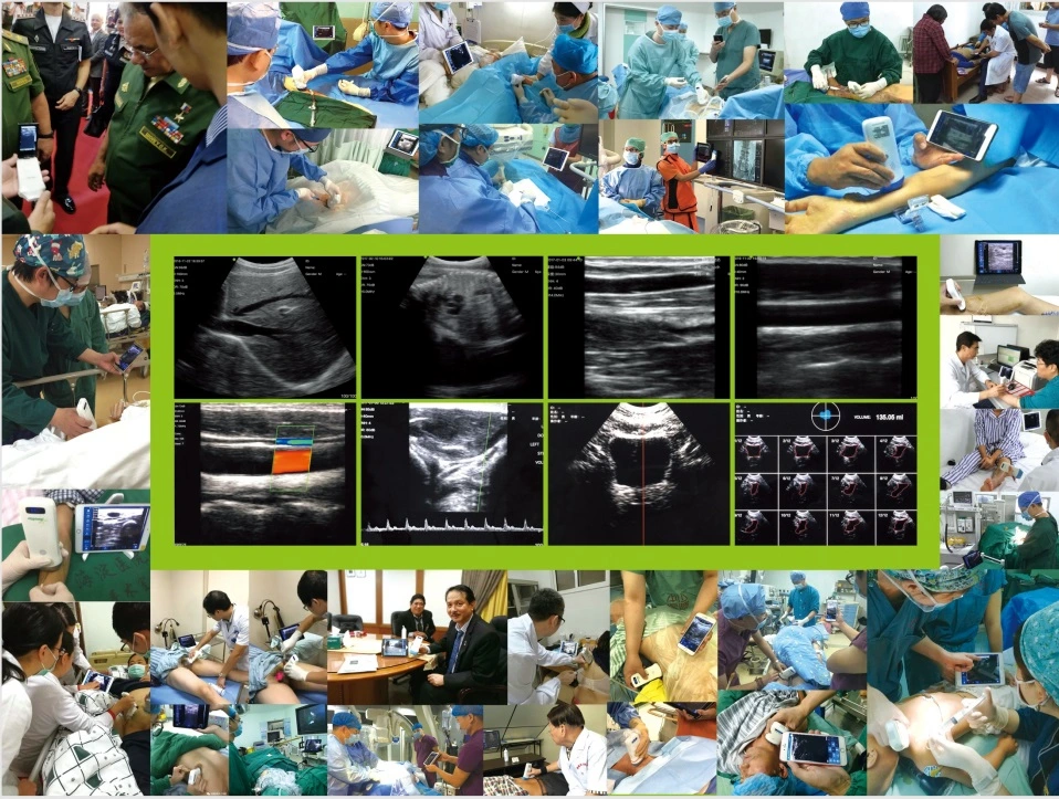 Latest Design Wireless Ultrasound Linear Probe for Hospital