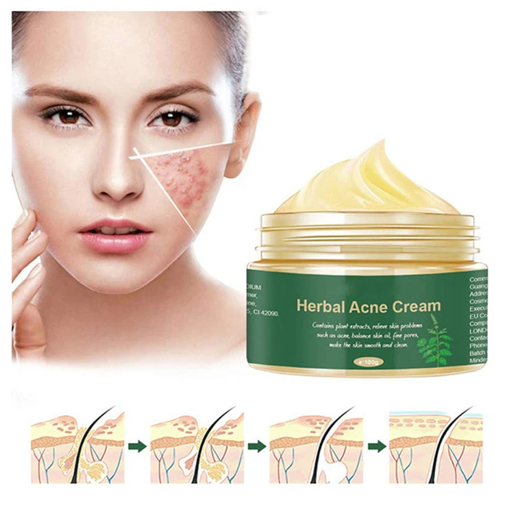 OEM Custom Herbal Acne Scar Removal Brightening Cream