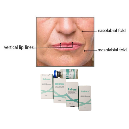 Topical Wrinkle Fillers Reborn 500mg plla fillers