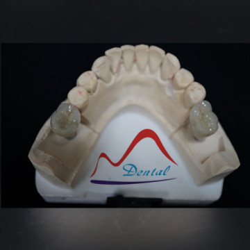 Cementable implant crown and bridge