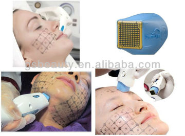 Thermage CPT skin rejuvenation face lift