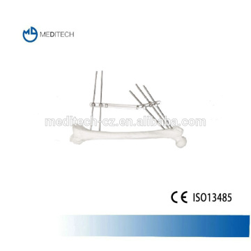 Dynamic External Fixator, Orthopedic External Fixation System