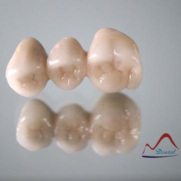 Double-end Dental Fixed Bridge