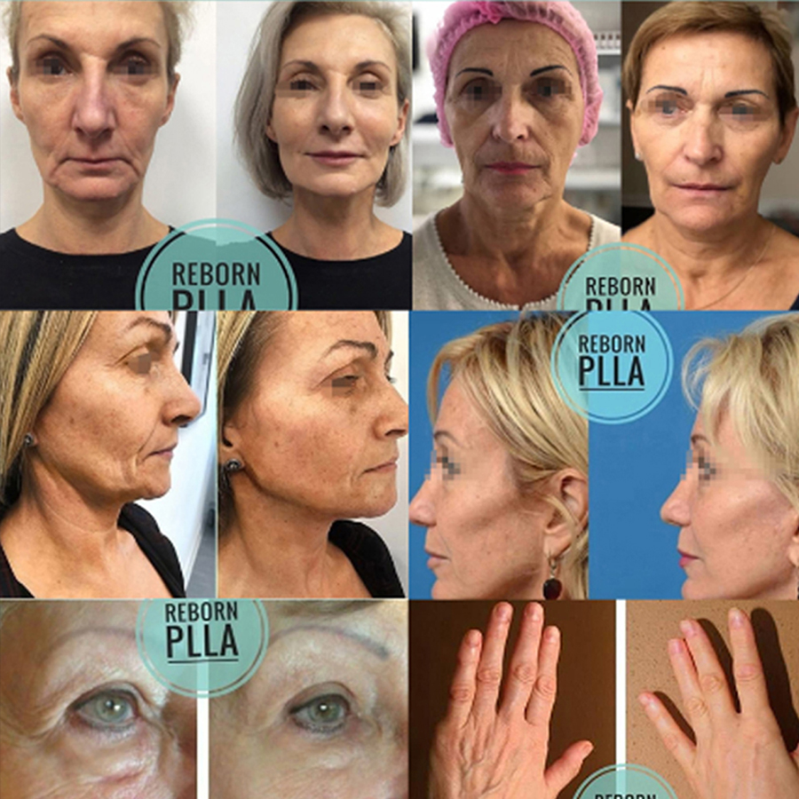 Effect of Reborn PLLA Dermal Filler