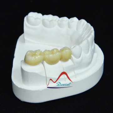 Full Contour Zirconia Crown and Bridge