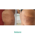 Butt Enhancement Strench Marks Removal Dermal Filler