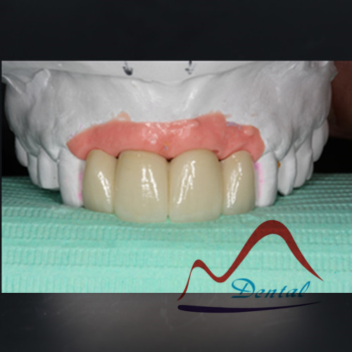 Implant crown and bridge with insertion key