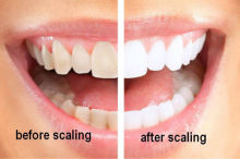 Tooth whitening machine PR-M208A