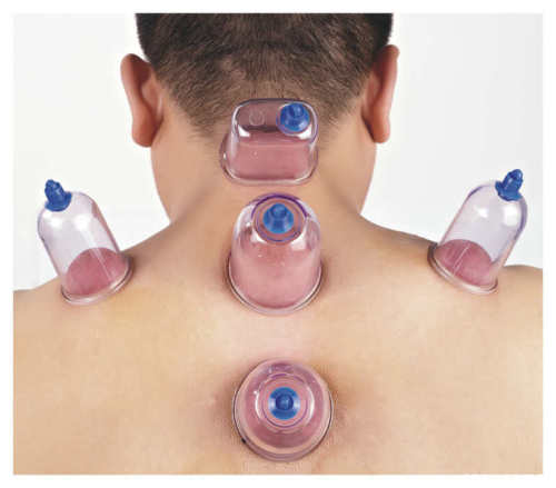 Chinese Vacuum Cupping Set
