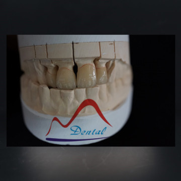 Emax Dental Crown Most Aesthetic Ceramic Crown
