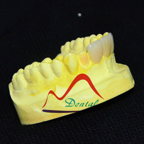 anterior dental emax veneers