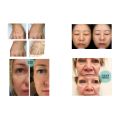 Non-surgical Face Rejuvenation PLLA Dermal Fillers