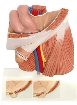 Inguinal Hernia Model